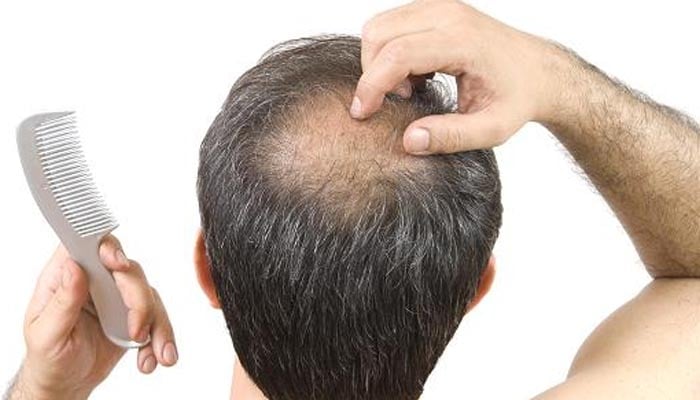 گنجے پن کا علاج دریافت کر لیا گیا