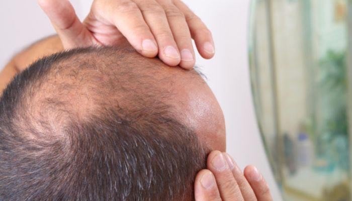 گنجے پن کا علاج دریافت کر لیا گیا