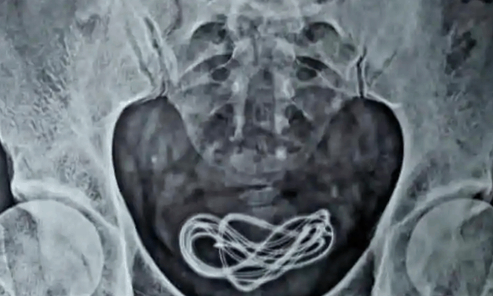 بھارت،ڈاکٹر نے مریض کے مثانے سے چارجر کی کیبل نکال لی 