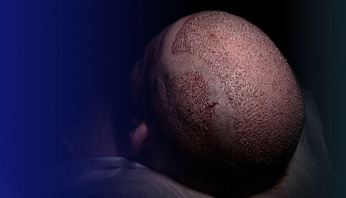 اتائیت کیخلاف موثر کارروائی ضروری، ہیئر ریسٹوریشن ماہرین