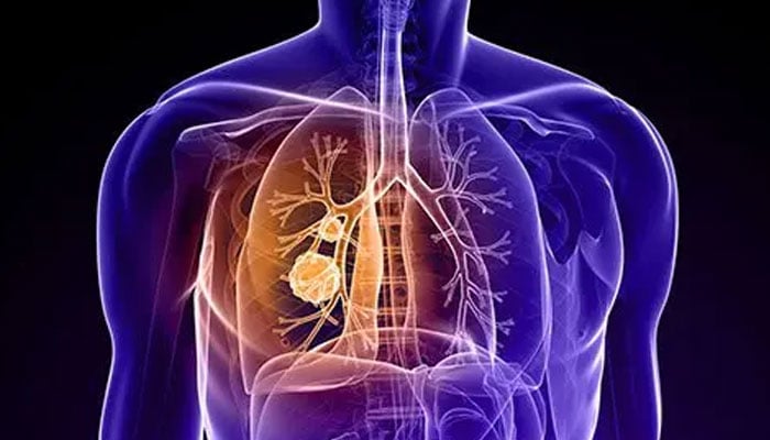 سائنسدانوں نے پھیپھڑوں کے کینسر میں اہم ٹیومر سیل کی شناخت کرلی