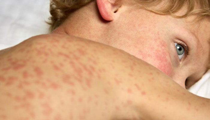 امریکا میں خسرہ کی 30 سالہ بدترین وبا، صحت نظام پر شدید دباؤ