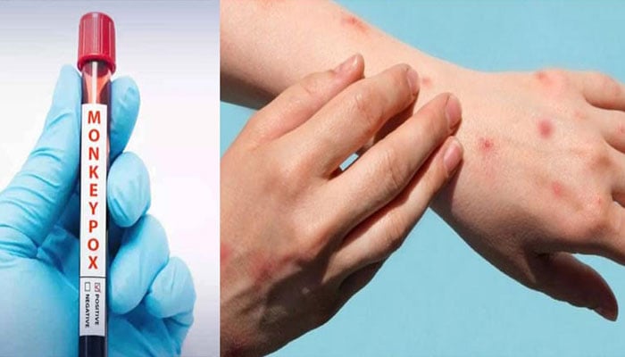 سندھ میں منکی پاکس کے 33 کیسز، 9 اموات