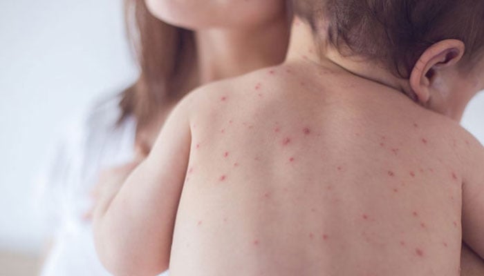 امریکا میں خسرہ کے کیسز کی تعداد ریکارڈ سطح پر پہنچ گئی