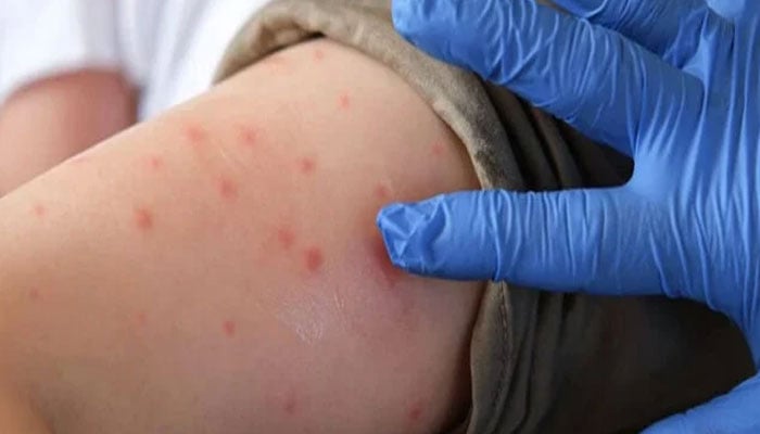 بنگلہ دیش میں خسرہ کی وبا، 1200 سے زائد بچوں کی اموات