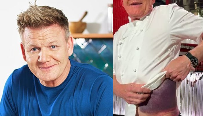 Gordon Ramsay shows terrible injuries from recent bike accident: ‘I'm ...