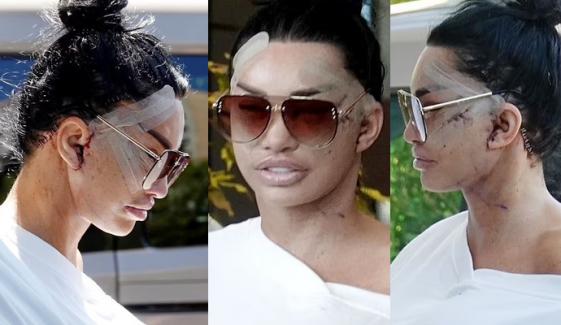 Katie Price spotted with bloodied, bruised face in bandages