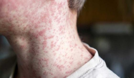 Measles: Symptoms, spread, treatment, and vaccine