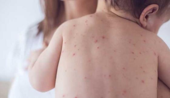 Measles outbreak in US causes first death in a decade