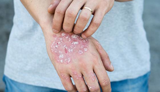 How to manage chronic inflammation with psoriasis