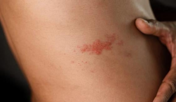 Shingles vaccine reduces the risk of cardiac diseases, study