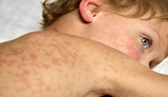 Measles outbreak: Almost 718 cases reported in Texas