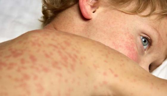 Measles outbreak in Liverpool: child passes away as cases surge