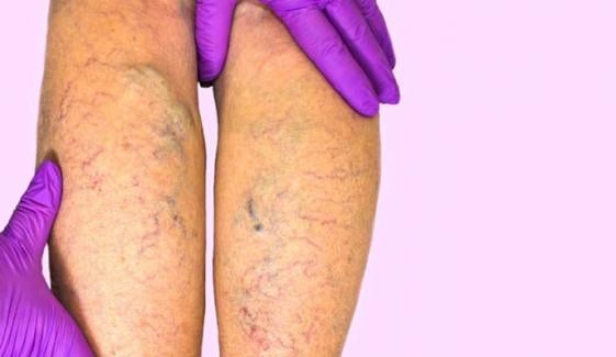 What is chronic venous insufficiency, condition affecting Donald Trump