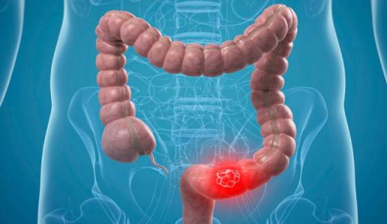 5 signs of colon cancer you should never ignore 