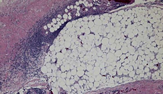 Flesh-eating bacteria killed 2 more people in Louisiana