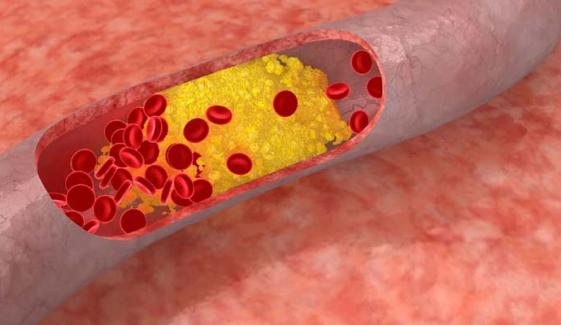 How to prevent atherosclerosis naturally with simple lifestyle changes