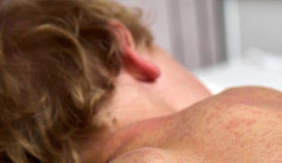 Measles rapidly spread across US, forcing hundreds of kids into quarantine