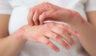Family stress during early-life may significantly increase psoriasis risk