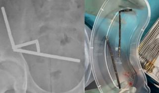 Temu under fire after New Zealand teen swallows 100 banned magnets bought from site