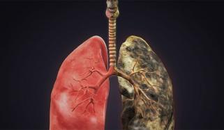 Lung cancer survival rates surge nationwide, Maryland shows increased progress