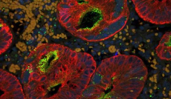 Canada’s measles outbreak causes Americas region to lose elimination status