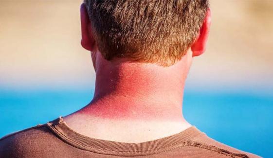 UV rays triggers inflammation that can cause skin cancer, study
