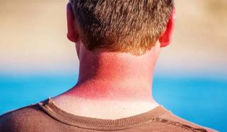 UV rays triggers inflammation that can cause skin cancer, study