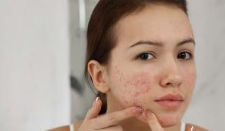Tips to combat dryness, irritation, and acne-prone skin