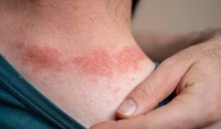 Iron deficiency common in moderate-to-severe Atopic Dermatitis, study finds