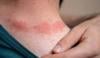 Iron deficiency common in moderate-to-severe Atopic Dermatitis, study finds
