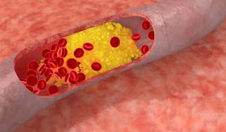 Women with heart disease face higher risk from angioplasty, study