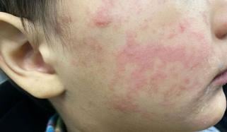 Measles outbreak in South Carolina exceeds 300 cases, spreads to other states