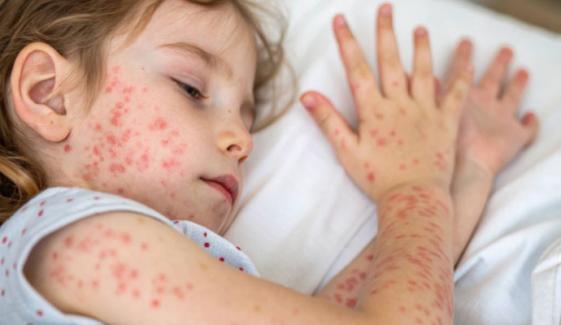Georgia reports first measles case of 2026