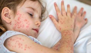 Georgia reports first measles case of 2026