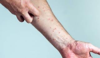 Scabies cases climb across UK this winter
