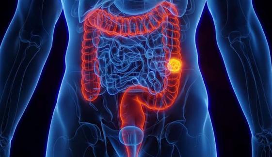 Colon cancer becomes leading cause of deaths in Americans under 50