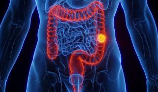 Colon cancer becomes leading cause of deaths in Americans under 50