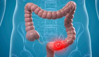 NHS reduces bowel cancer test threshold to improve early diagnosis