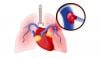 What is Pulmonary Embolism? Symptoms, diagnosis, treatment 