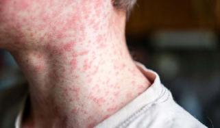 Officials issue health alert in UK due to rapidly increasing Measles cases in schools
