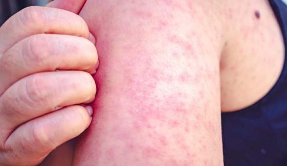 Health officials confirm 6 new measles cases in local jail in New Mexico