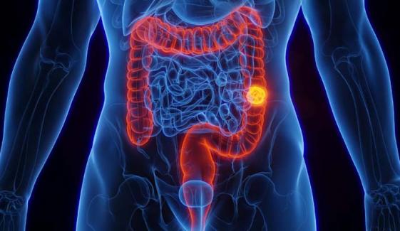 THESE symptoms in people under 45 may require Colorectal cancer screening
