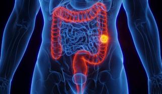 THESE symptoms in people under 45 may require Colorectal cancer screening