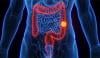 New blood test offers alternative for colon cancer screening