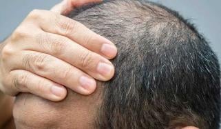 Weight loss drugs may increase risk of hair loss, study