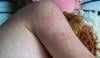 US measles crisis deepens as two unvaccinated people die in Pennsylvania