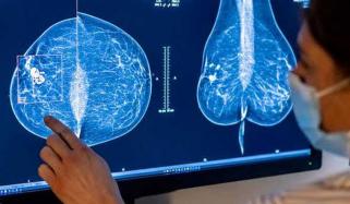 AI cleared to review mammograms without radiologists, raising job concerns
