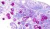 US declares largest Cyclospora outbreak over after 12,000 cases 