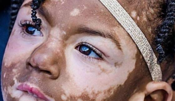 White Skin Disease
